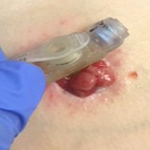 Mild prolapse example 1
