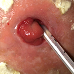 Severe prolapse example 1
