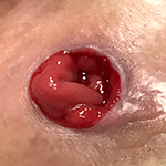 Severe prolapse