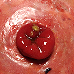 Severe prolapse example 3