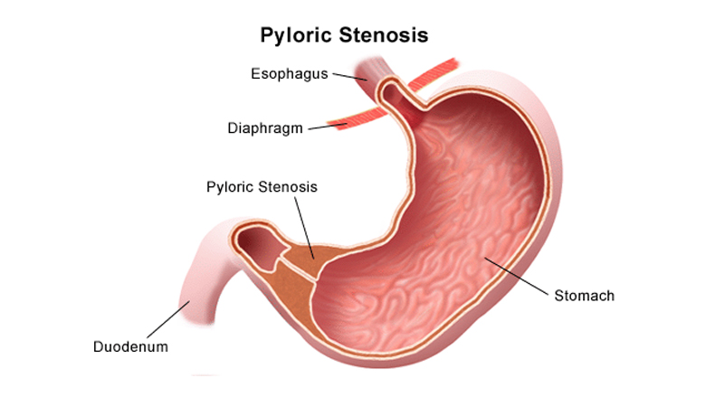 Pyloric Stenosis | Children's Hospital of Philadelphia