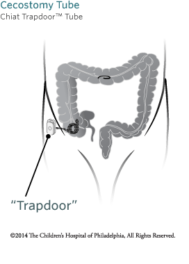 About Percutaneous Cecostomy Tube Trap Door Image