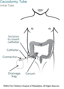 About Percutaneous Cecostomy Tube Image