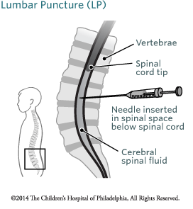 Lumbar Puncture Image