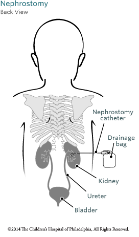 Nephrostomy Back View Image