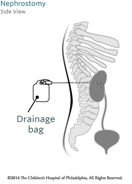 Nephrostomy Tube Side View Image