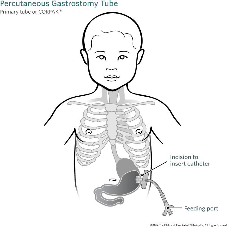 percutaneous gastrostomy feeding tube placement childrens gastrostomy
