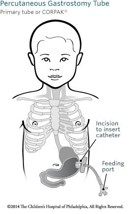 Percutaneous Endoscopic Gastrostomy Peg Tube Placement Children S Hospital Of Philadelphia