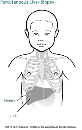 Percutaneous Liver Biopsy Image