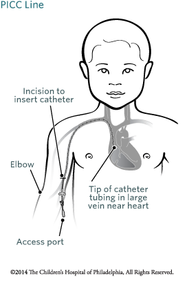 Peripherally Inserted Central Catheter (PICC) Image