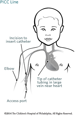 Peripherally Inserted Central Catheter (PICC) | Children's Hospital of ...