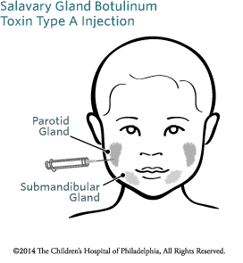 Salavary Gland Botulinum Toxin Type A Injection Image