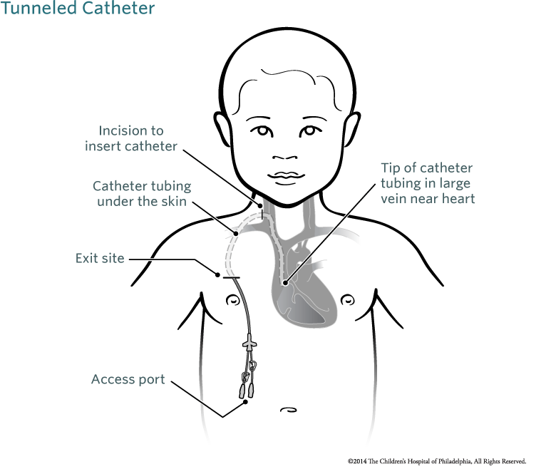 Central Venous Catheter Locations