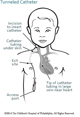 Tunneled Catheter Image