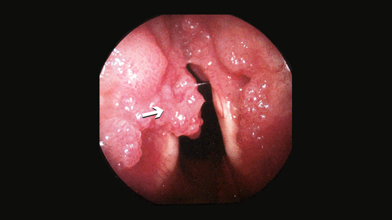 Respiratory papillomatosis laryngeal