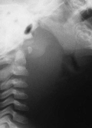 Retropharyngeal Abscess