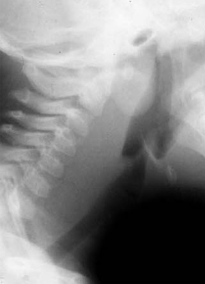 Retropharyngeal Cellulitis
