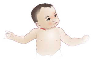 Right Torticollis