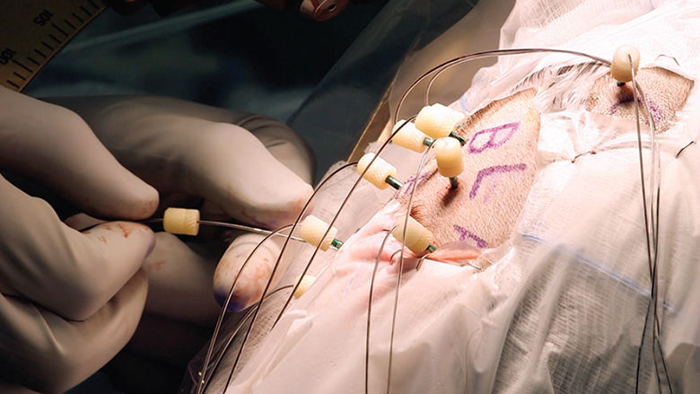 Robotic-assisted stereoelectroencephalography Robotic-assisted stereoelectroencephalography