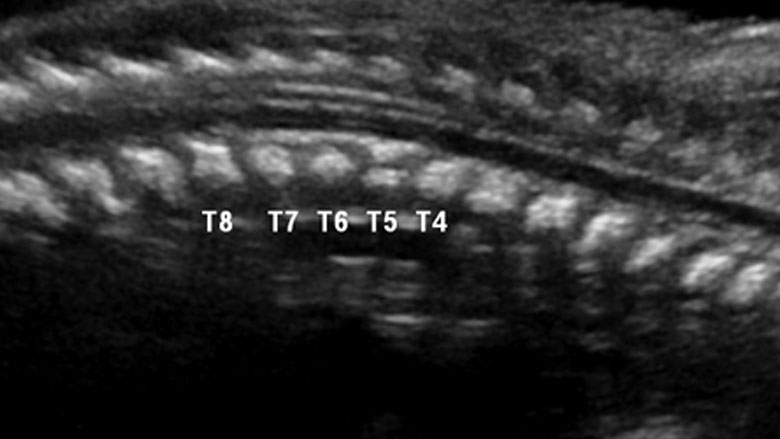 Fetal CT showing sagittal view of single anomalous vertebrae Fetal CT showing sagittal view of single anomalous vertebrae