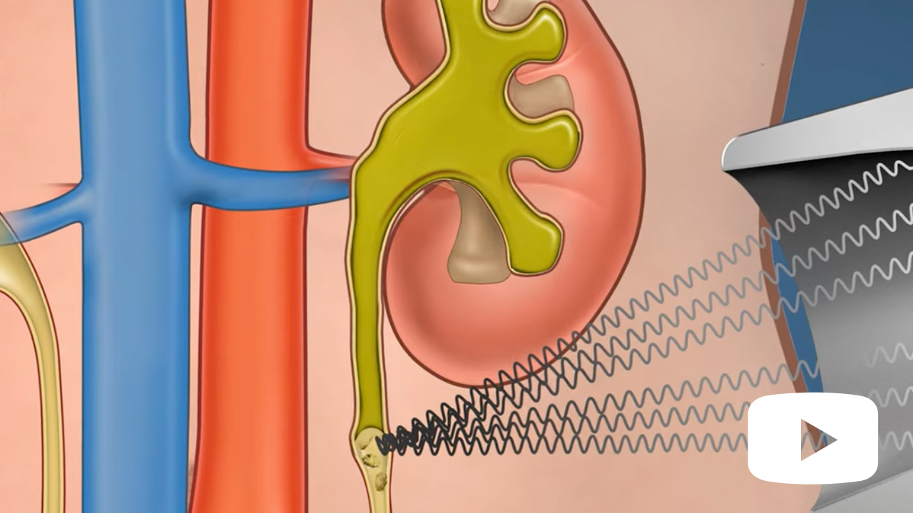 Urology Shockwave Lithotripsy