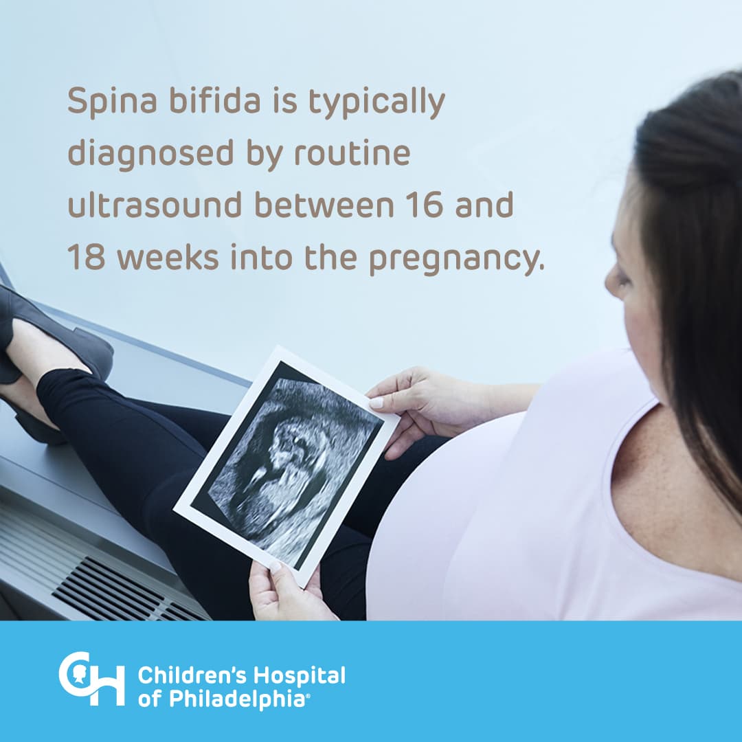 Spina Bifida is typically diagnosed by routine ultrasound between 16 and 18 weeks into the pregnancy.