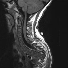 spinal tb mri