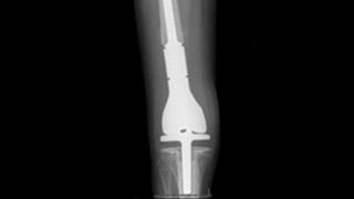 Postoperative X-ray