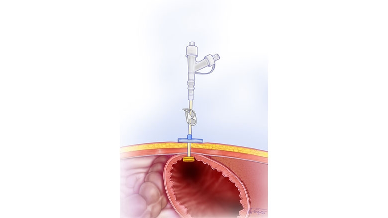 Percutaneous Gastrostomy tube