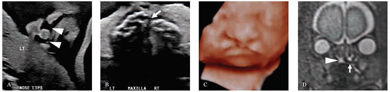 Images of 27-week fetus with right cleft lip and palate and left cleft lip 