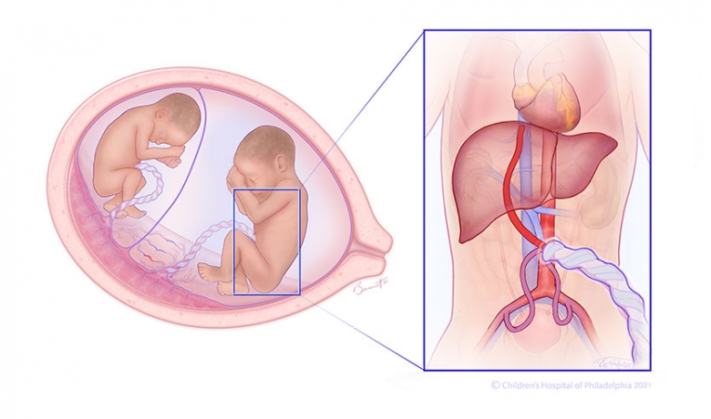 Twin-to-twin transfusion syndrome (TTTS) stage 3 illustration