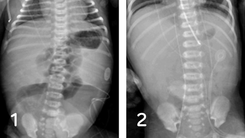 Side-by-side-abdominal radiographs