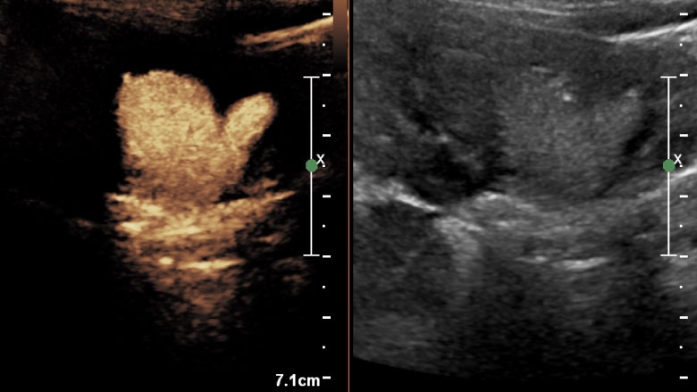 Dual display contrast-enhanced ultrasound image (left) and grayscale reference (right). Coronal view of the left kidney with the child in the prone position. Grade 3 VUR is present in the lower pole of the left duplex kidney.