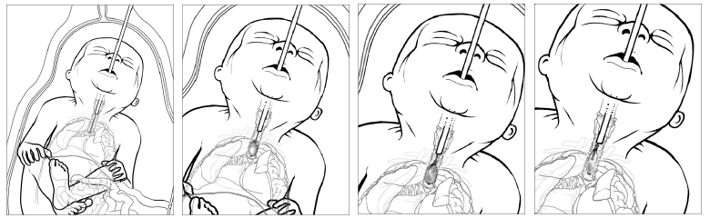 four illustrations of balloon in unborn baby airway