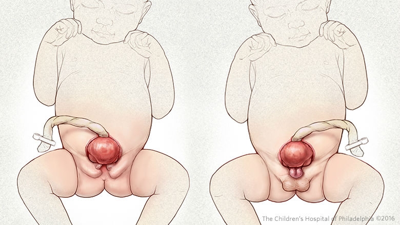 Illustration of female and male babies with exposed bladder caused by bladder exstrophy.