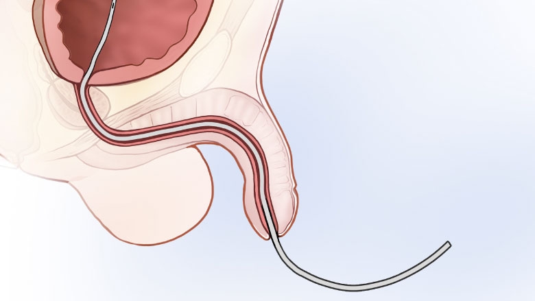 Catheter depiction