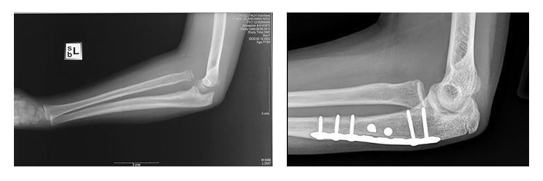 Clairianna's elbow X-rays