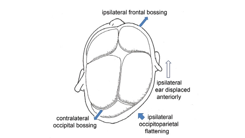 deformational-plagiocephaly illustration