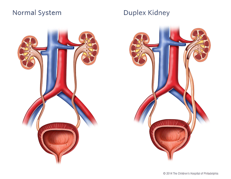 Duplex Kidney Illustration