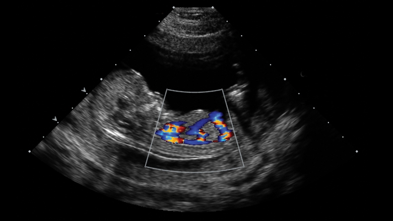 early gestational fetal cardiovascular imaging