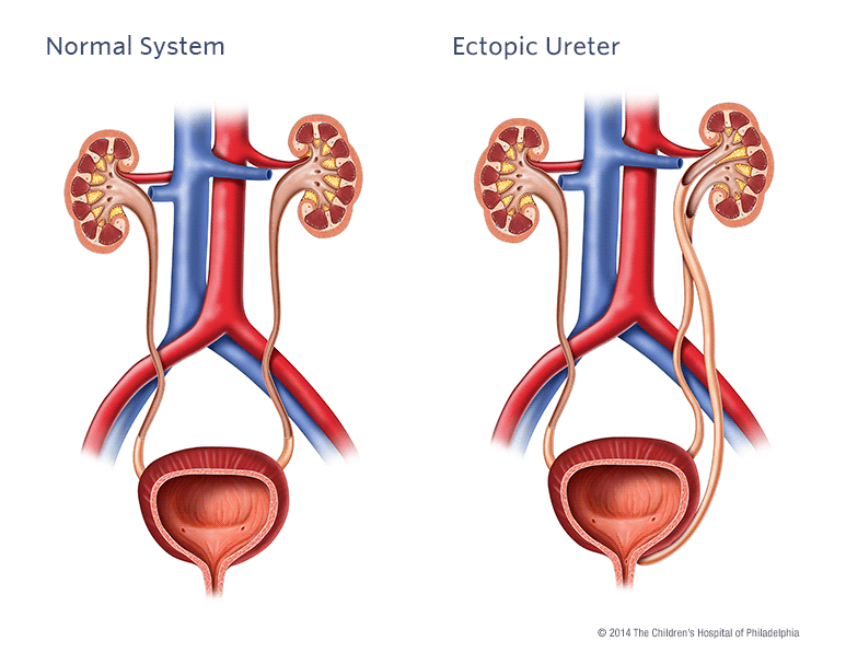 Ectopic Ureter Illustration