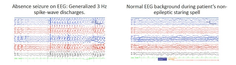 Comparison of EEG charts