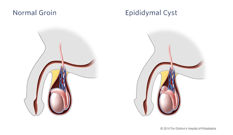 Epididymal Cyst and Spermatocele