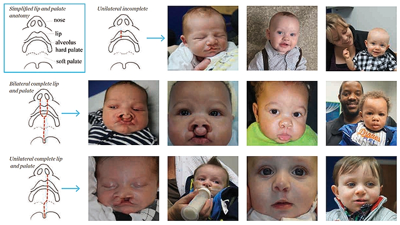 Photo collage of evolution of cleft lip and palate surgery