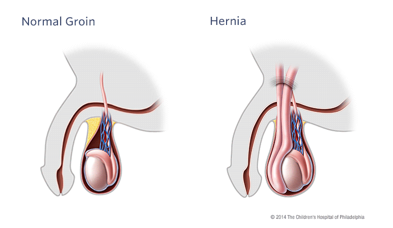 Hydrocele and Hernia Illustration
