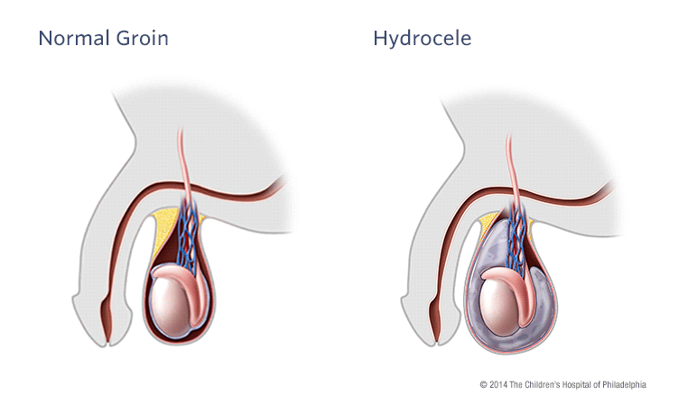 Hydrocele Illustration