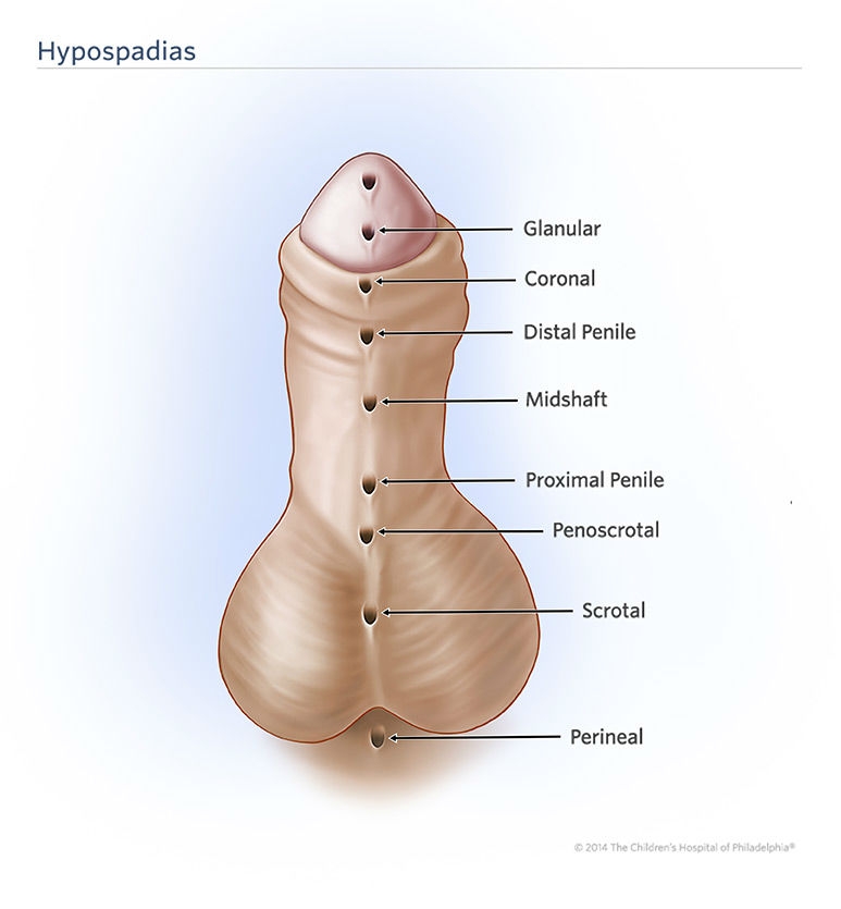 Hypospadias illustration