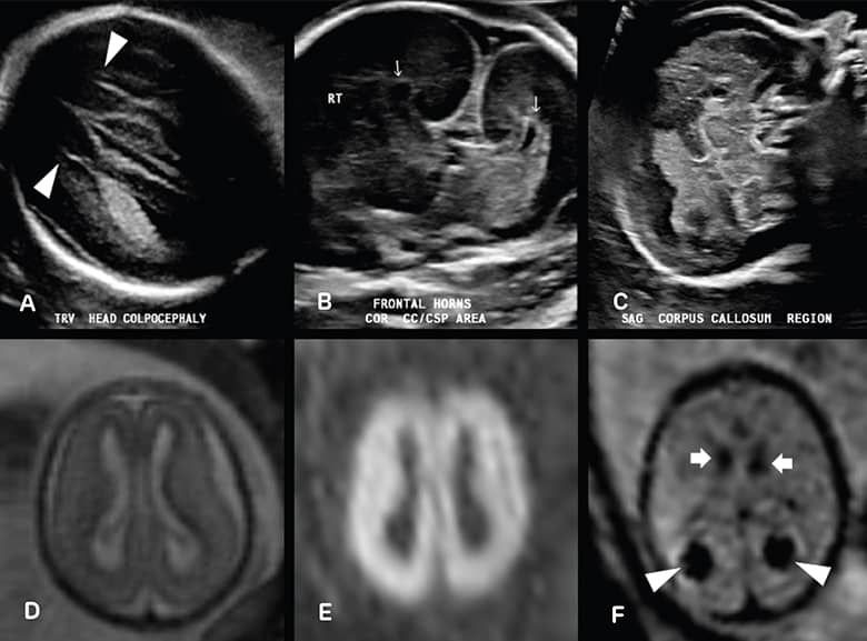 Six MRI photos that show examples of hypoxic brain injury