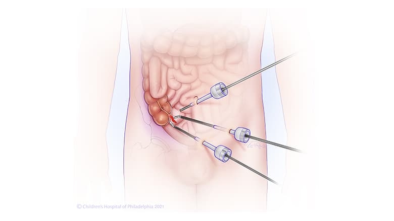 Illustration of appendectomy patient overview