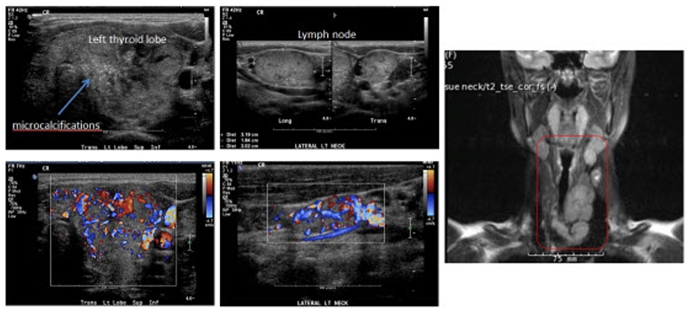 thyroid cancer ultrasound image